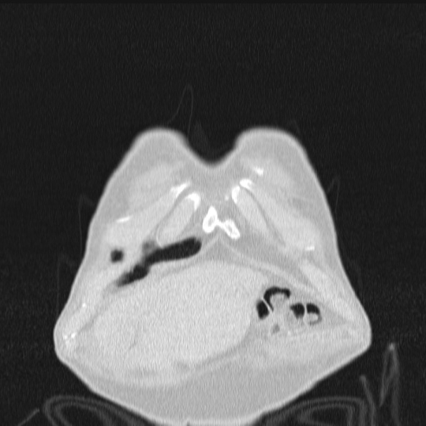 Azygos lobe (Radiopaedia 38259-40275 Coronal lung window 7).jpg