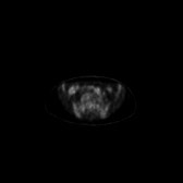B-cell lymphoma of the mesentery (Radiopaedia 65743-74868 18F-FDG PET-CT 100).jpg
