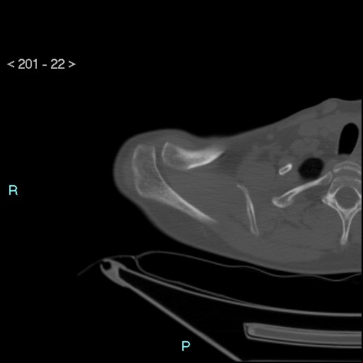Bankart lesion with glenoid bone defect - assessment TC with PICO method (Radiopaedia 42855-93901 Axial bone window 21).jpg