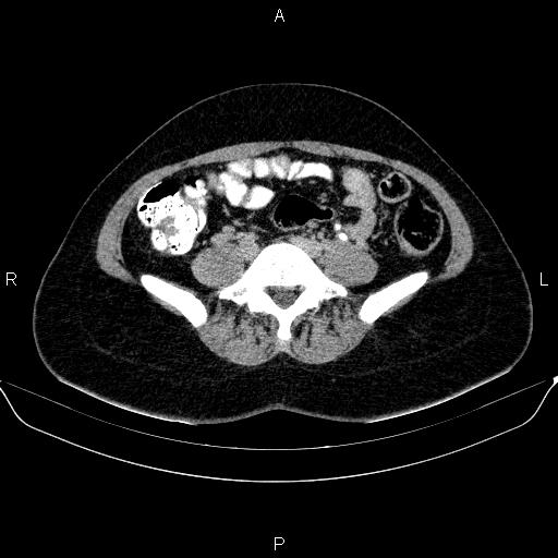 File:Bartholin gland cyst (Radiopaedia 62635-70930 C 5).jpg