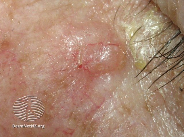 File:Basal cell carcinoma (DermNet NZ vascular-telangiectases-14).jpg