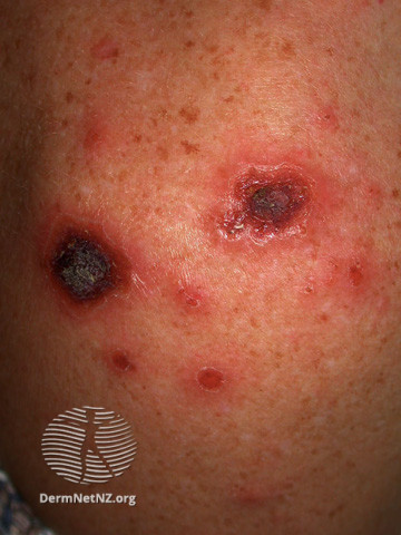 Basal cell carcinoma affecting the face (DermNet NZ lesions-bcc-face-0870).jpg