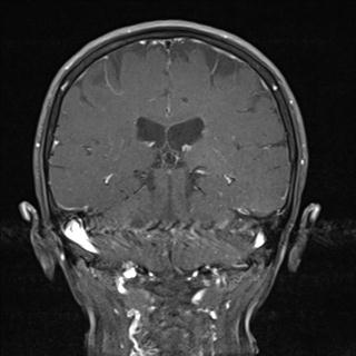 File:Base of skull chondrosarcoma (Radiopaedia 30410-31070 G 16).jpg