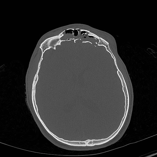 Base of skull fracture with bilateral Le Fort fractures (Radiopaedia 47094-51638 Axial bone window 54).jpg