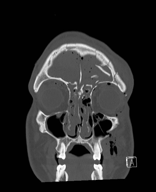 Base of skull fracture with bilateral Le Fort fractures (Radiopaedia 47094-51638 Coronal bone window 81).jpg