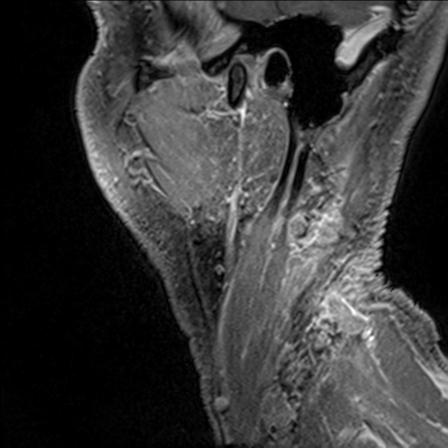 Base of tongue squamous cell carcinoma (Radiopaedia 31174-31884 F 18).jpg