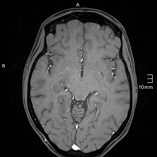 Basilar artery perforator aneurysm (Radiopaedia 82455-99523 F 66).jpg