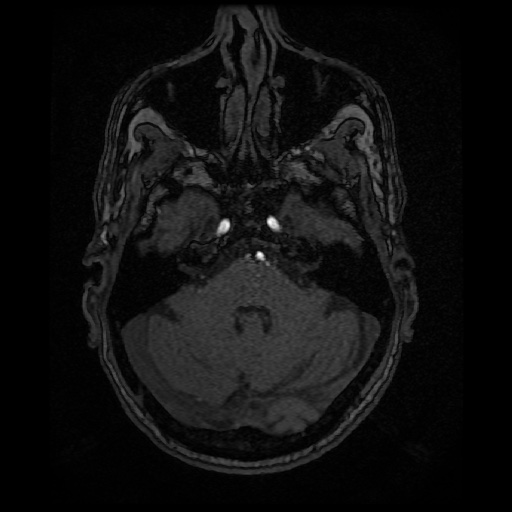Basilar top and left middle cerebral artery aneurysm (Radiopaedia 61965-70031 Axial MRA 34).jpg