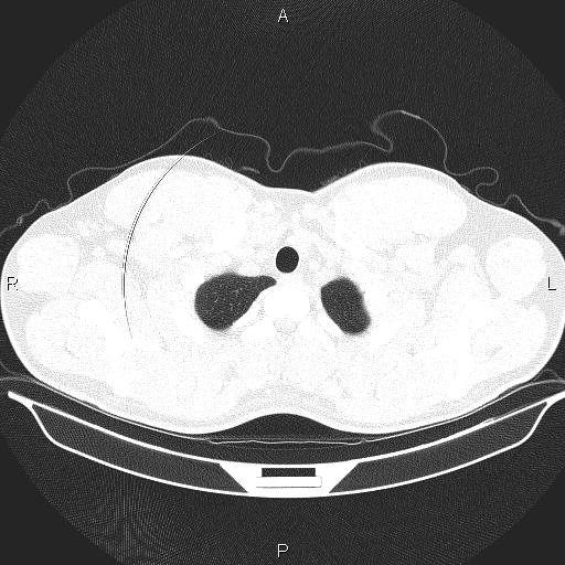 File:Beam hardening and ring artifacts (Radiopaedia 85323-100915 Axial lung window 9).jpg