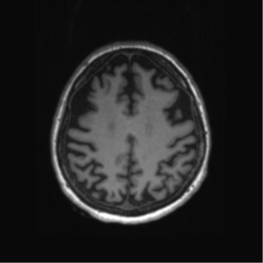 Behavioral variant frontotemporal dementia and late onset schizophrenia (Radiopaedia 52197-58083 Axial T1 23).png
