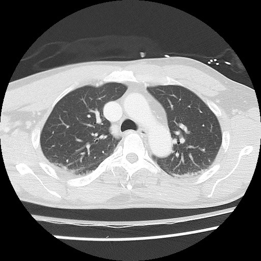 Benign post-traumatic pseudopneumoperitoneum (Radiopaedia 71199-81495 Axial lung window 28).jpg