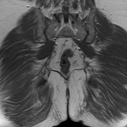 File:Benign prostatic nodular hyperplasia (Radiopaedia 16917-16634 Coronal T1 18).jpg