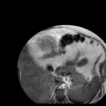 File:Benign seromucinous cystadenoma of the ovary (Radiopaedia 71065-81300 Axial T1 36).jpg