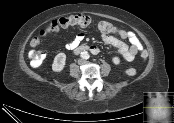 Bicameral celiacomesenteric aneurysm (Radiopaedia 55766-62327 A 37).jpg