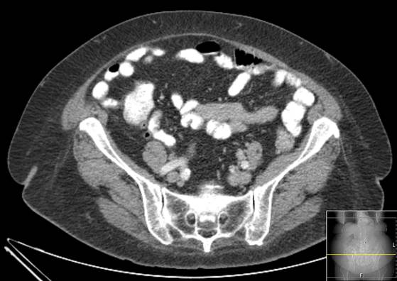 File:Bicameral celiacomesenteric aneurysm (Radiopaedia 55766-62327 A 50).jpg
