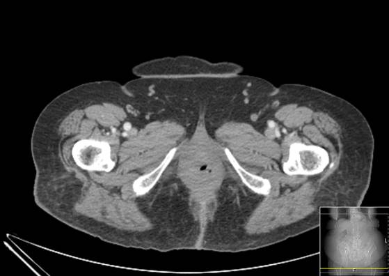 Bicameral celiacomesenteric aneurysm (Radiopaedia 55766-62327 A 80).jpg
