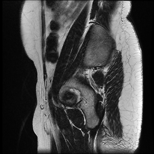 File:Bicornuate uterus (Radiopaedia 51676-57472 Sagittal T2 24).jpg