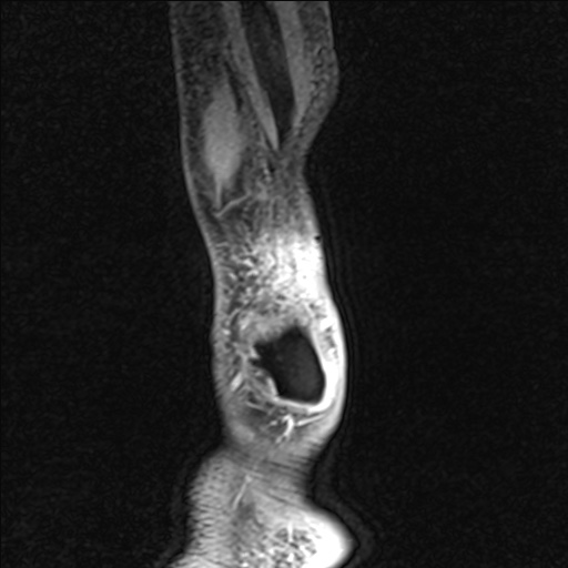 File:Bilateral Achilles tendon complete tear (Radiopaedia 81344-95051 Sagittal WE - Left 102).jpg