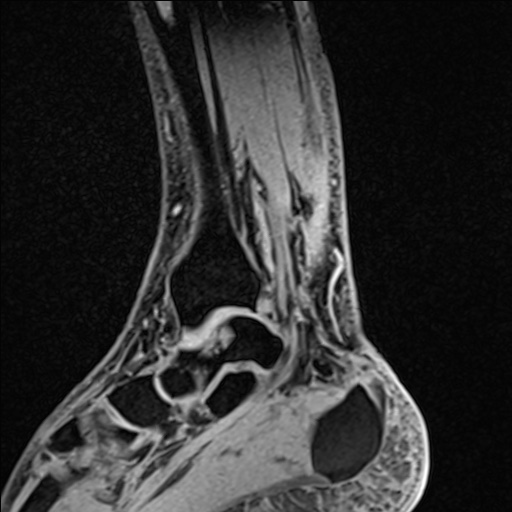 Bilateral Achilles tendon complete tear (Radiopaedia 81344-95051 Sagittal WE - Left 44).jpg