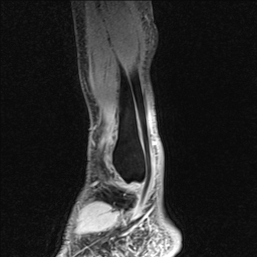 Bilateral Achilles tendon complete tear (Radiopaedia 81344-95051 Sagittal WE - Left 96).jpg