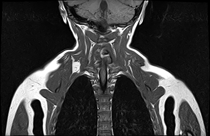 File:Bilateral Sprengel deformity with Klippel-Feil syndrome (Radiopaedia 66395-75650 Coronal T1 17).jpg