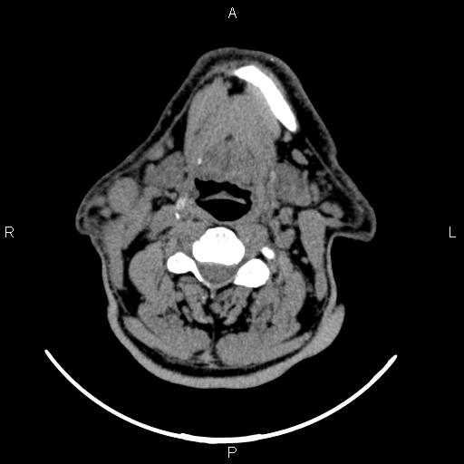 Bilateral Warthin tumors (Radiopaedia 84034-99263 Axial non-contrast 33).jpg
