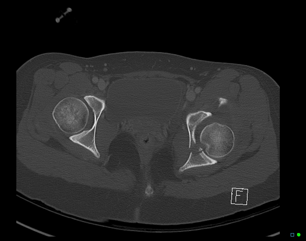 Bilateral acetabular fractures (Radiopaedia 79272-92308 Axial bone window 47).jpg