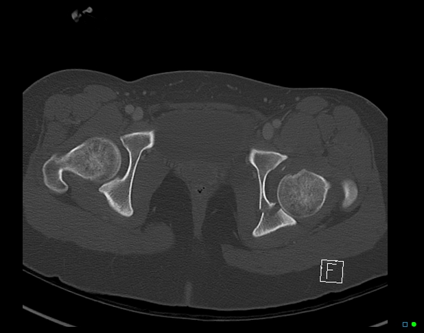 Bilateral acetabular fractures (Radiopaedia 79272-92308 Axial bone window 50).jpg