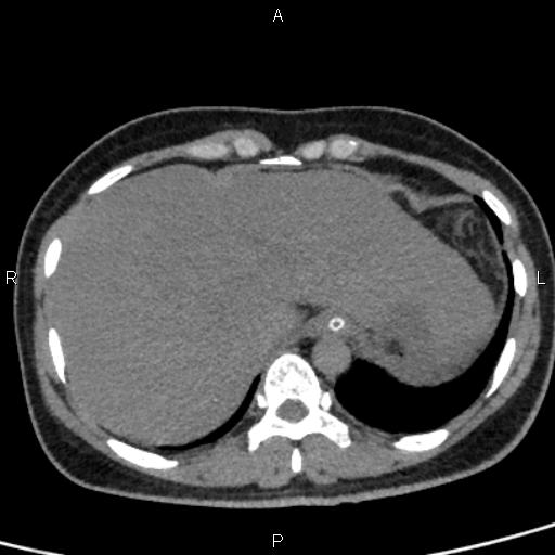 Bilateral adrenal gland hyperenhancement in pancreatitis (Radiopaedia 86642-102753 Axial non-contrast 14).jpg