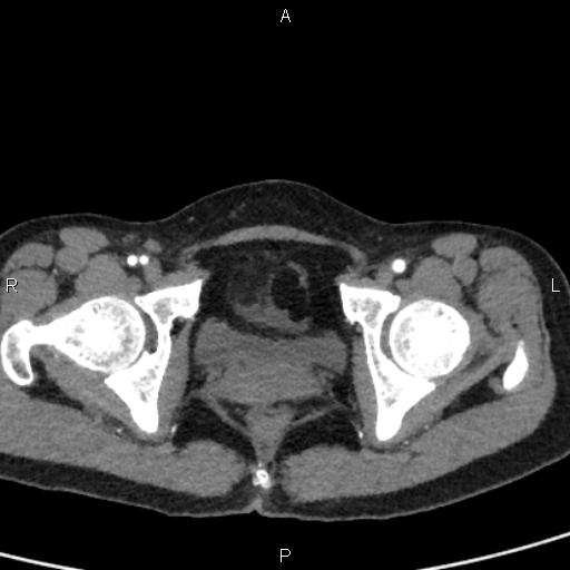 Bilateral adrenal gland hyperenhancement in pancreatitis (Radiopaedia 86642-102753 B 121).jpg