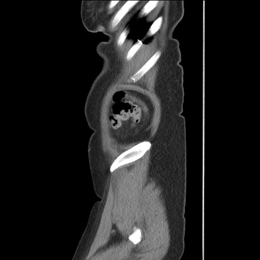 File:Bilateral adrenal granulocytic sarcomas (chloromas) (Radiopaedia 78375-91007 C 124).jpg