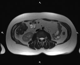 File:Bilateral adrenal myelolipoma (Radiopaedia 63058-71537 Axial T2 23).jpg