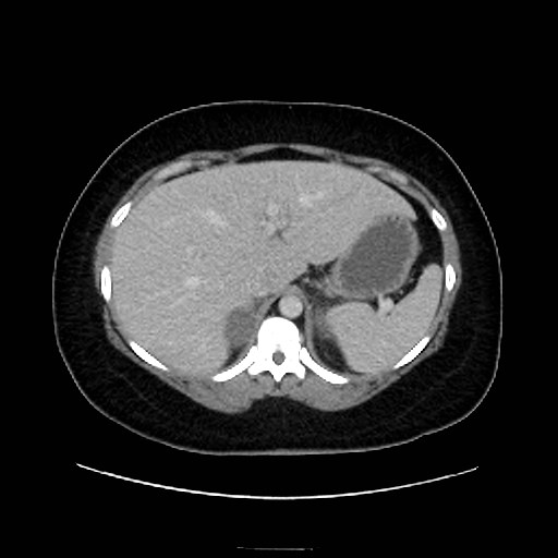Bilateral adrenal thrombosis (Radiopaedia 58182-65256 A 14).jpg