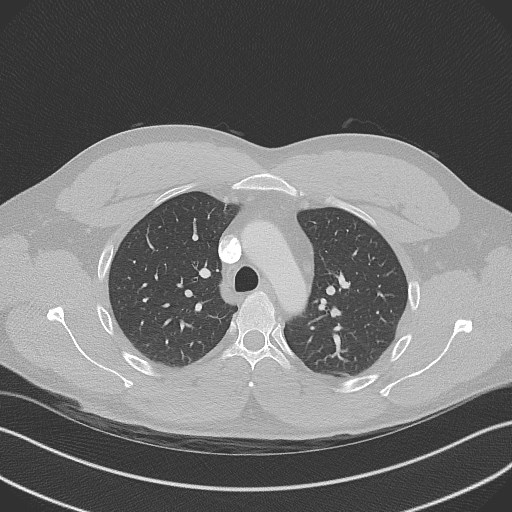 Bilateral atelectasis (Radiopaedia 48666-53675 Axial lung window 34).jpg