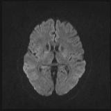 File:Bilateral basal ganglia and thalamic T1 hyperintensities (Radiopaedia 19764-19802 Axial DWI 30).jpg
