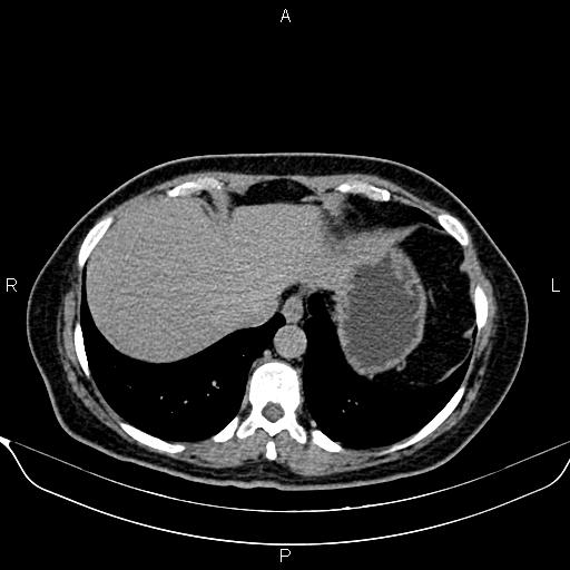 Bilateral benign adrenal adenomas (Radiopaedia 86912-103124 Axial C+ delayed 1).jpg