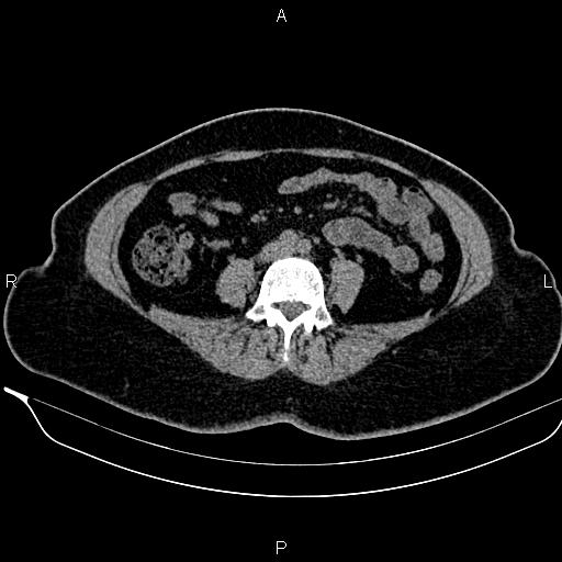 Bilateral benign adrenal adenomas (Radiopaedia 86912-103124 Axial non-contrast 69).jpg