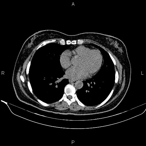 Bilateral benign adrenal adenomas (Radiopaedia 86912-103124 Axial non-contrast 7).jpg