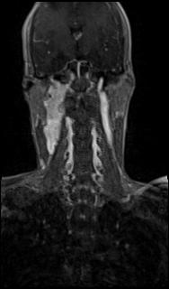 File:Bilateral carotid body tumors and right glomus jugulare tumor (Radiopaedia 20024-20060 MRA 38).jpg