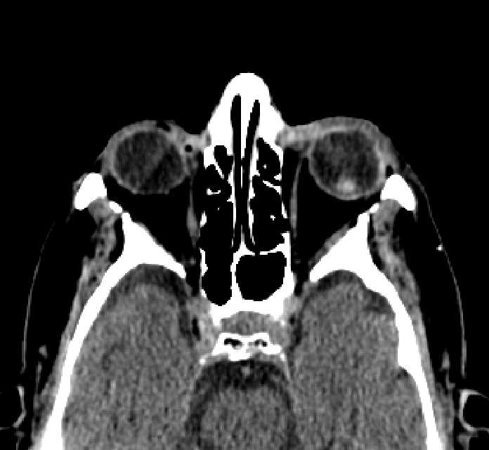 Bilateral ectopia lentis (Radiopaedia 89889-107013 Axial non-contrast 49).jpg