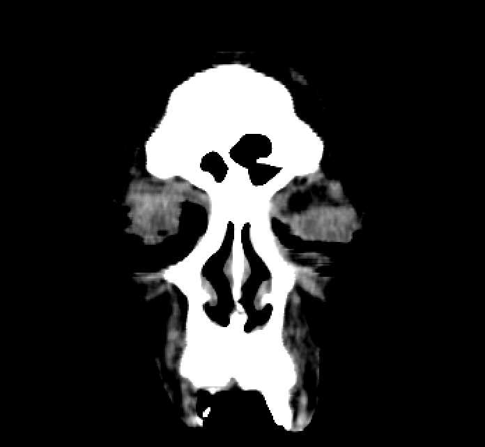 Bilateral ectopia lentis (Radiopaedia 89889-107013 Coronal non-contrast 7).jpg