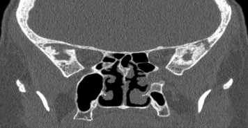 File:Bilateral ectopic infraorbital nerves (Radiopaedia 49006-54084 Coronal 11).png