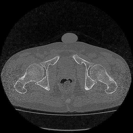 Bilateral femoral neck stress fractures (Radiopaedia 28666-28954 Axial bone window 44).png