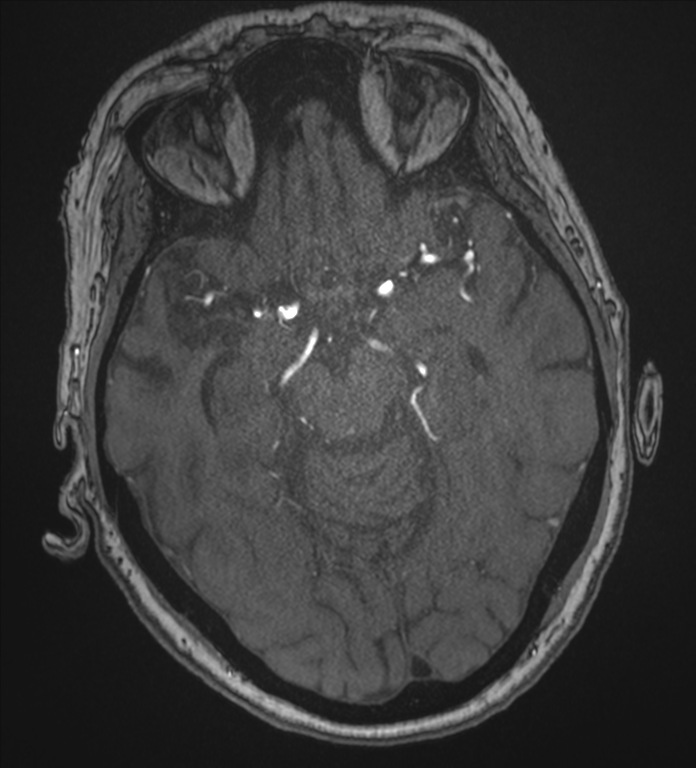 Bilateral fetal posterior communicating arteries (Radiopaedia 41286-44102 Axial MRA 80).png