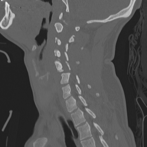 Bilateral locked facets (Radiopaedia 33850-35016 Sagittal bone window 29).png