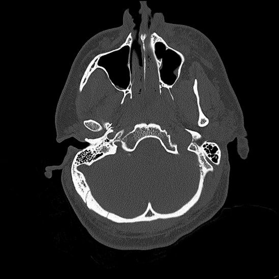 Bilateral occipital condyle fracture (type 2) (Radiopaedia 87675-104089 Axial bone thins 40).jpg