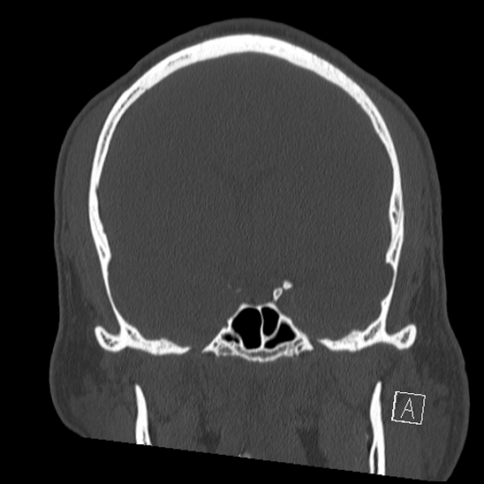 Bilateral occipital condyle fracture (type 2) (Radiopaedia 87675-104089 Coronal bone window 52).jpg