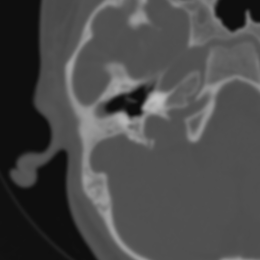 Bilateral otosclerosis (Radiopaedia 57237-64157 B 48).jpg