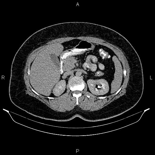 Bilateral ovarian dermoid cysts (Radiopaedia 85785-101603 Axial C+ delayed 22).jpg