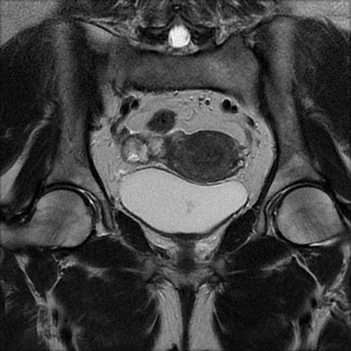 File:Bilateral ovarian dermoid cysts (Radiopaedia 90152-107338 Coronal T2 15).jpg